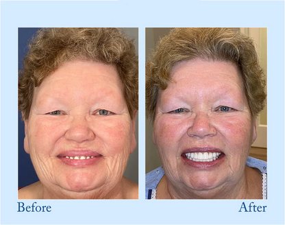 NATRAVOR® - Premium Denture